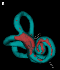 Figure: Labyrinth affected by Ménière’s disease (Gurkov, Berman et al. 2015).