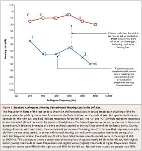 Figure: Idealized audiogram compatible with idiopathic sudden sensorineural hearing loss, from Rausch 2008.