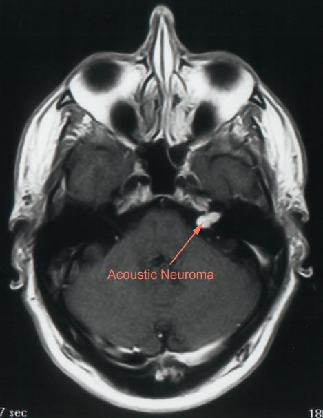 Intracanalicular vestibular schwannoma. From http://www.waent.org/archives/2010/Vol3-1/20090614-aco