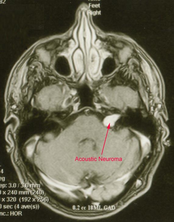 Intra- and extra-canalicular vestibular schwannoma. From http://www.waent.org/archives/2010/Vol3-1/20090614-acoustic-neuroma/acoustic-neuroma.htm