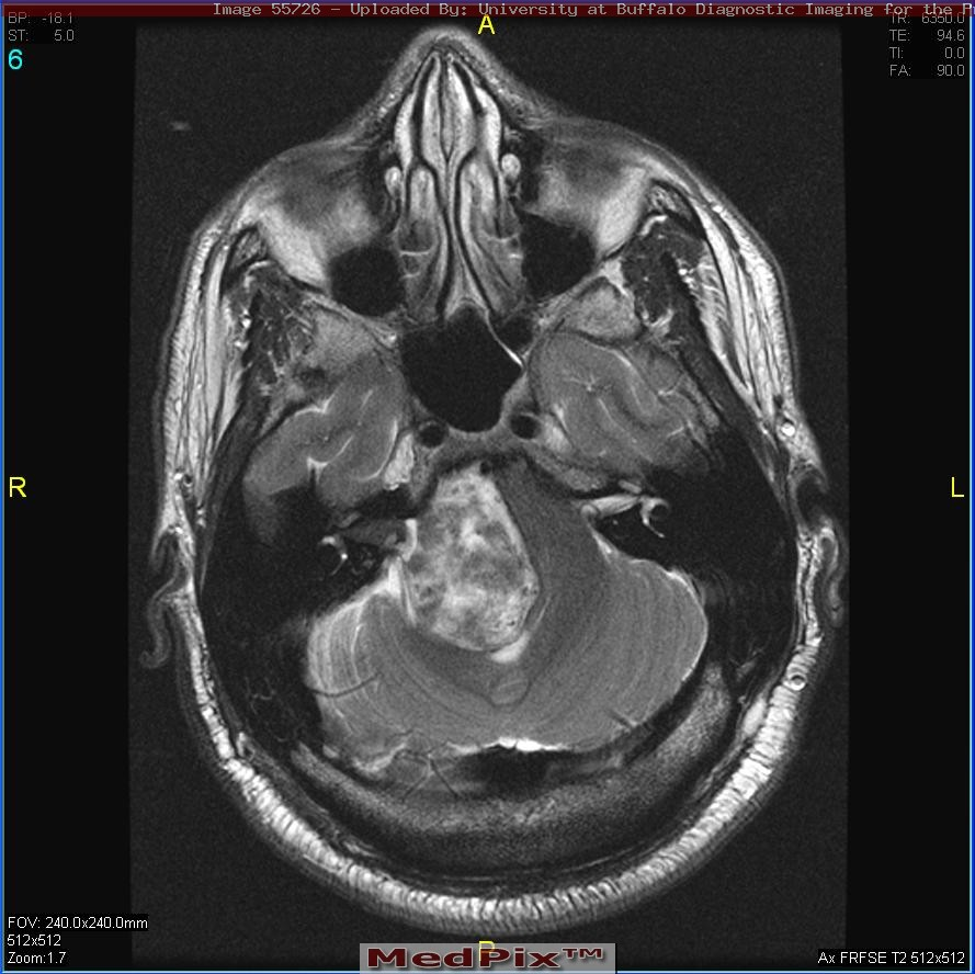 Intra- and extra-canalicular location, with brainstem compression. From http://rad.usuhs.edu/medpix/cow_image.html?pt_id=13912&imid=55726&quiz=&week=#top