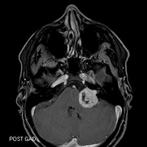Intra- and extra-canalicular location, with brainstem compression. From http://stvincentsent.com.au/index.php/acoustic-tumour/