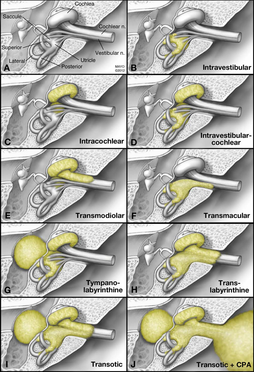 Figure: Variable locations of vestibular schwannomas