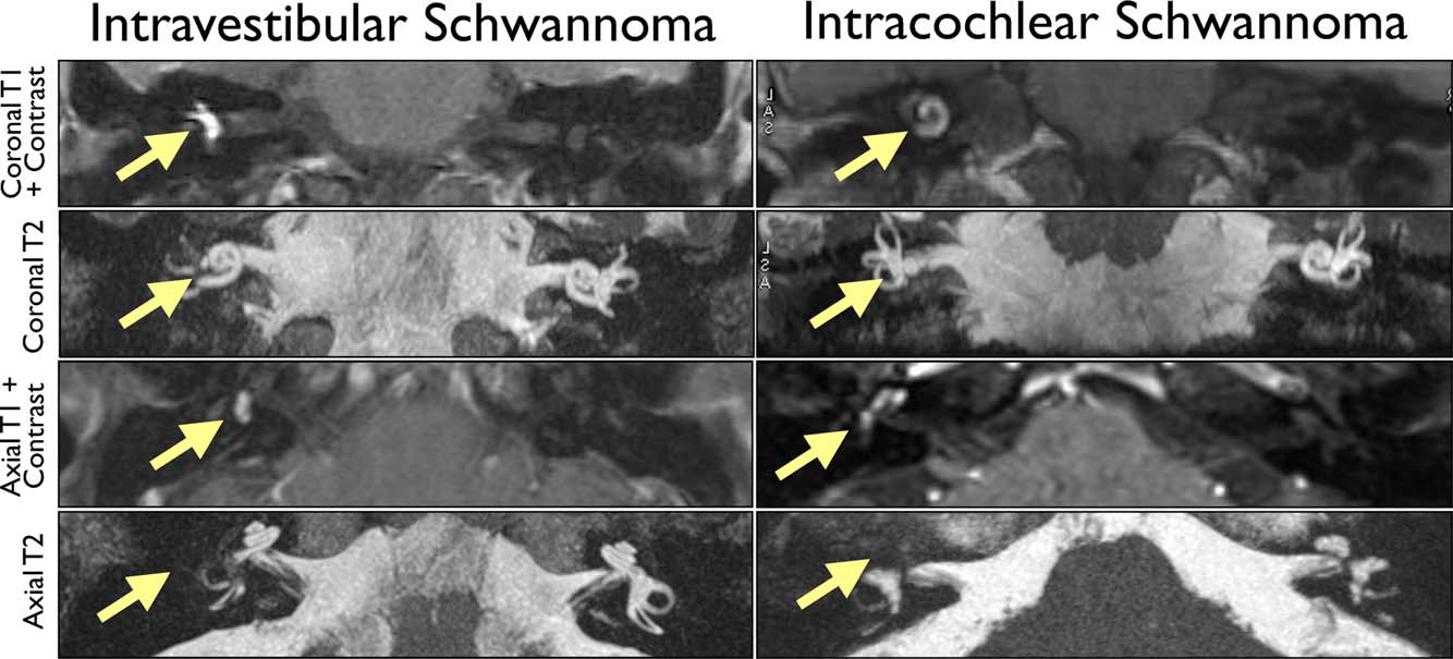 Intra-labyrinthine schwannomas. From (Van Abel et al., 2013)