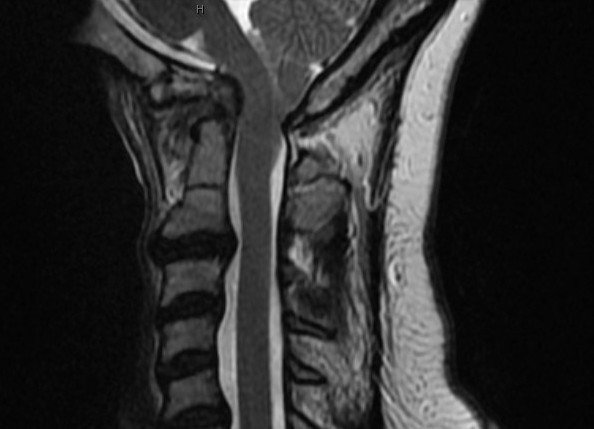 Basilar invagination: Sagittal cervical spine T2 weighted MRI shows an abnormal inferoposterior clivus compressing the medulla.