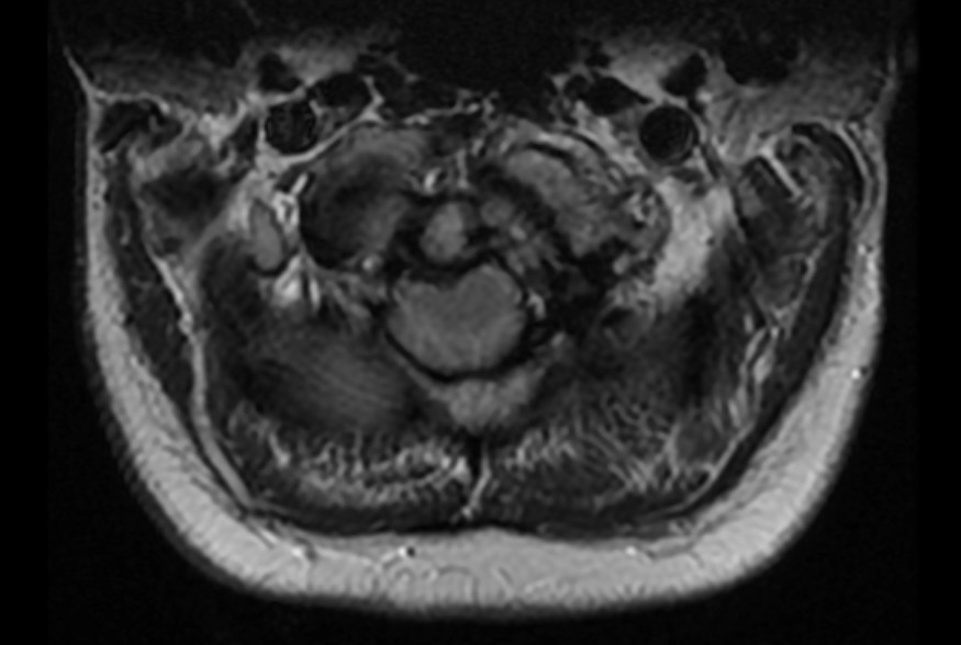 Basilar invagination: Axial T2 weighted brain MRI shows a crowded foramen magnum, with no cerebrospinal fluid around the craniocervical junction.