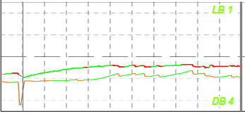Basilar invagination: Spontaneous down beat nystagmus on primary position of gaze.