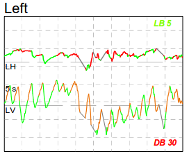 Basilar invagination: Left gaze significantly augmented the baseline down beat nystagmus.