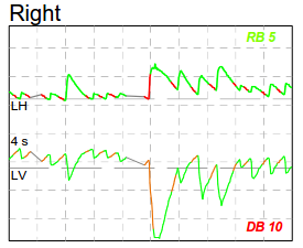 Basilar invagination: Right gaze significantly augmented the baseline down beat nystagmus.