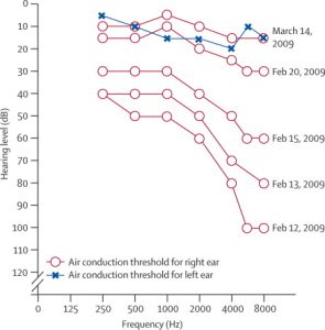 Figure: composite audiogram of recovery from sudden sensorineural hearing loss (from Schreiber 2010).