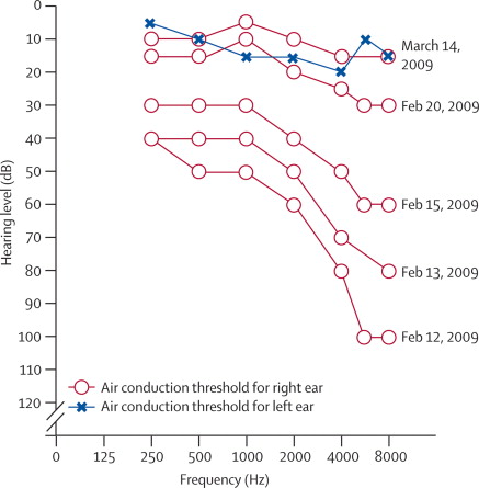 Figure: composite audiogram of recovery from sudden sensorineural hearing loss (from Schreiber 2010).