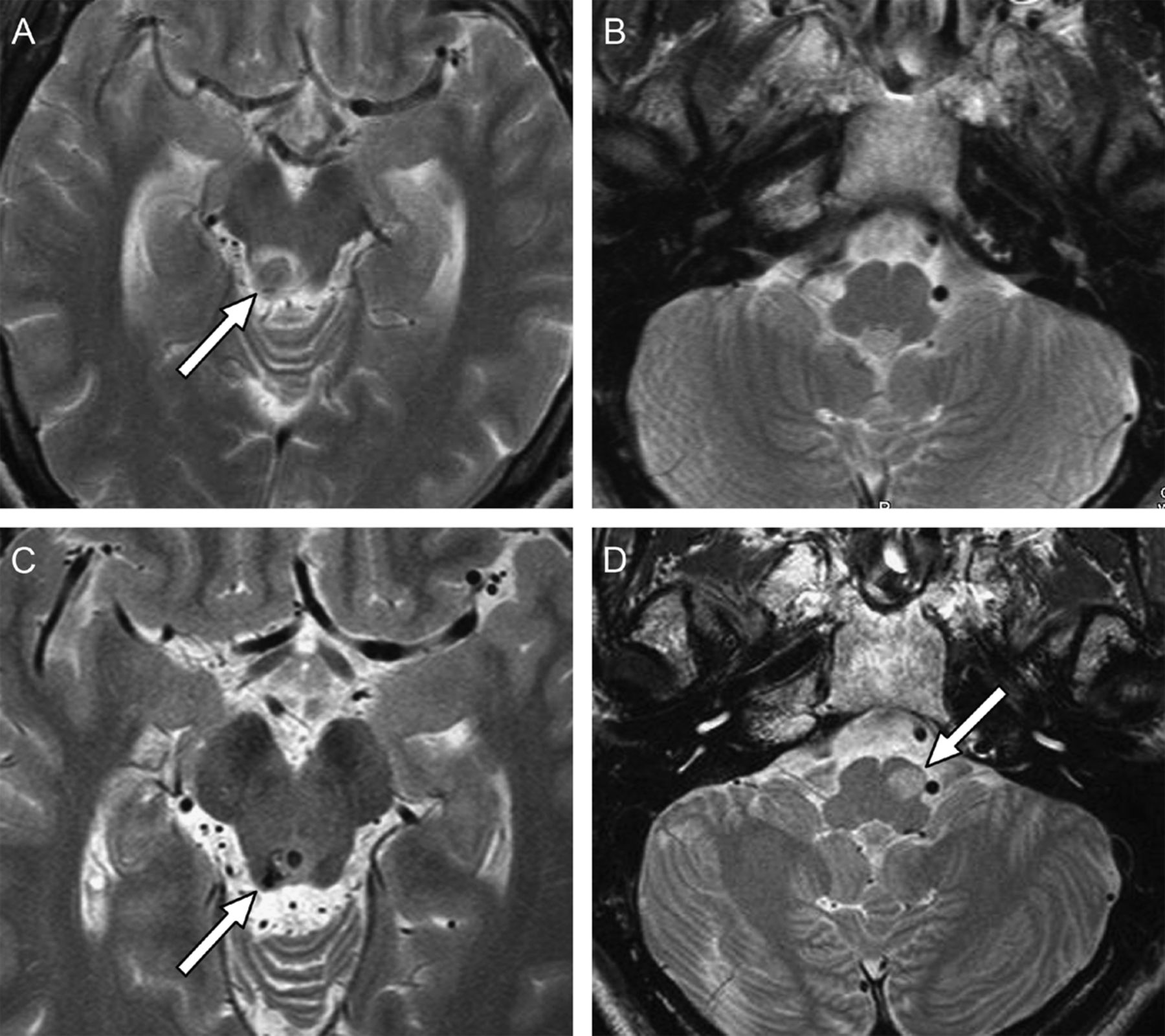 Figure: Series of MRIs.  Panel (A) shows a hemorrhage in the right inferior colliculus.  At the time of that hemorrhage, Panel (B) shows that the medulla was normal.  After three months, Panel (C) shows that the hemorrhage in the inferior colliculus had resolved, whereas at that time Panel (D) shows hypertrophic degeneration of the left inferior olive.  From Jang and Borruat (2013).