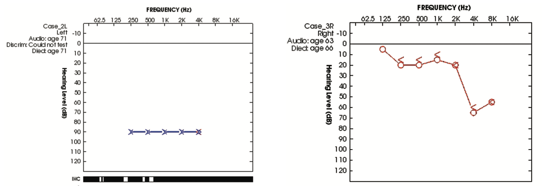 Figure: Audiogram from a patient who had suffered a left-sided labyrinthine concussion, from Ishai and colleagues (2018).