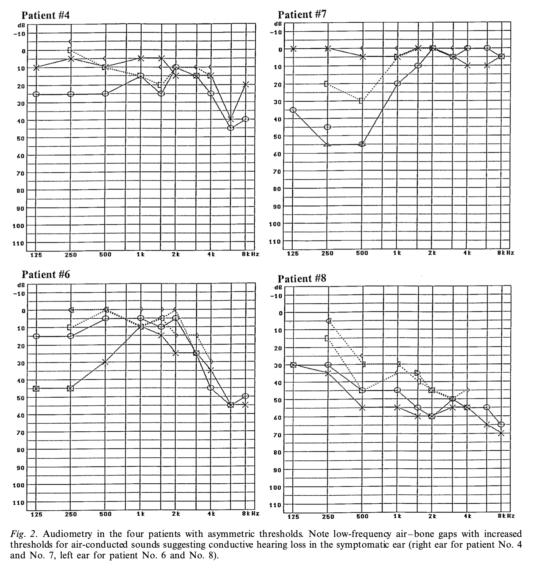 Figure: Audiograms from patients with superior semicircular canal dehiscence showing air-bone gaps and/or conductive hyperacusis in the affected ear.  From Brantberg et al. (2001).