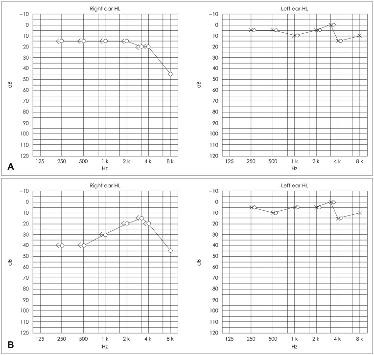 Figure: Audiometry from a case of post-traumatic endolymphatic hydros.  The audiogram in Panel A is from the time of admission; the right side showed moderate hearing loss at 8 kHz.  The audiogram in Panel B shows new right-sided moderate low frequency sensorineural hearing loss.  From Chung et al. (2014).