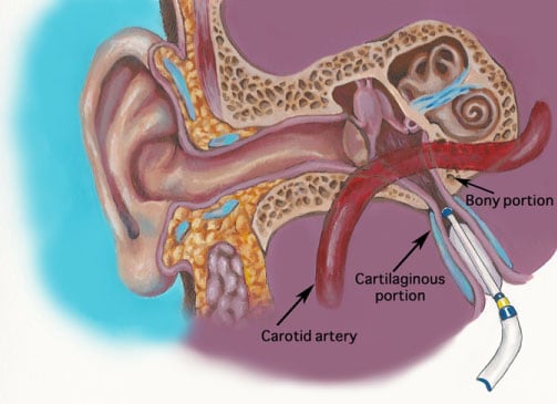 Figure: Balloon dilation Eustachian tuboplasty.  From http://www.clevelandnasalsinus.com/balloon-dilation-eustachian-tube.html (accessed 2/16/23).