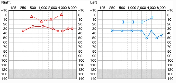 Figure: Bilateral conductive hearing loss in a case of bilateral chronic suppurative otitis media.  From Zaidi and Sinha (2013).