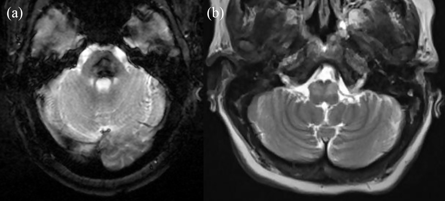 Figure: Bilateral inferior olivary hypertrophy in a patient status post resection of a medulloblastoma (from Behzadi et al. 2021).