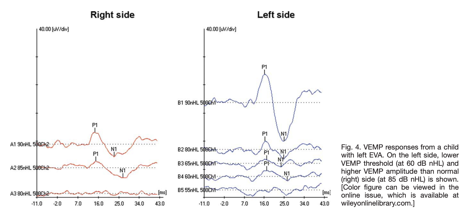 Figure: Cervical vestibular evoked myogenic potentials in a patient with left-sided large vestibular aqueduct.  The left-sided responses (right panel) exhibit unusually large amplitudes and unusually low thresholds.  From Zhou and Gopen (2011).