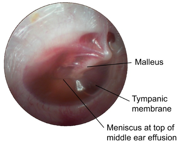 Figure: Fluid meniscus visible from a serous middle ear effusion.  From Bhutta et al. (2017).