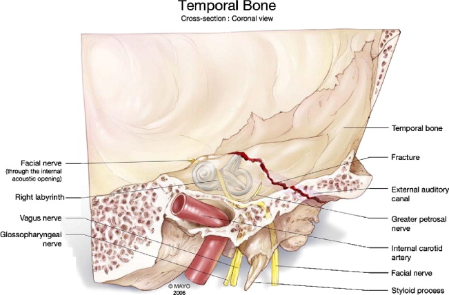 Figure: Illustration of a longitudinal temporal bone fracture traversing the external auditory canal but sparing the otic capsule.  From Gladwell and Viozzi (2008).