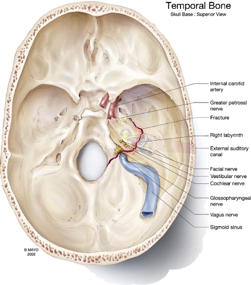 Figure: Illustration of a transverse temporal bone fracture involving the otic capsule.  From Gladwell and Viozzi (2008).