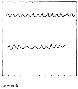Figure: Immittance tympanometry in a patient with palatal myoclonus showing spikes occurring at a frequency of about 80 per minute (from East and Hazell 1987).