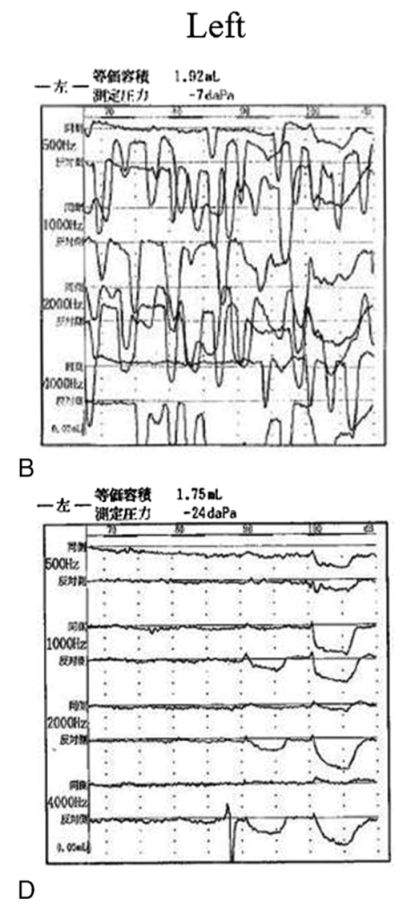 Figure: Impedance tympanometry from a patient with left-sided tensor tympani myoclonus pre-surgically (panel B) and post-surgically (panel D) (from Hidaka et al. 2013).