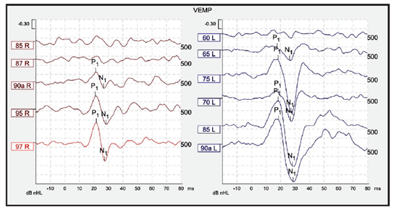 Figure: In a case of left-sided superior semicircular canal dehiscence, cervical vestibular evoked myogenic potentials ipsilateral to the lesion show unusually large amplitudes and an unusually low threshold.  From Mercado et al (2017).