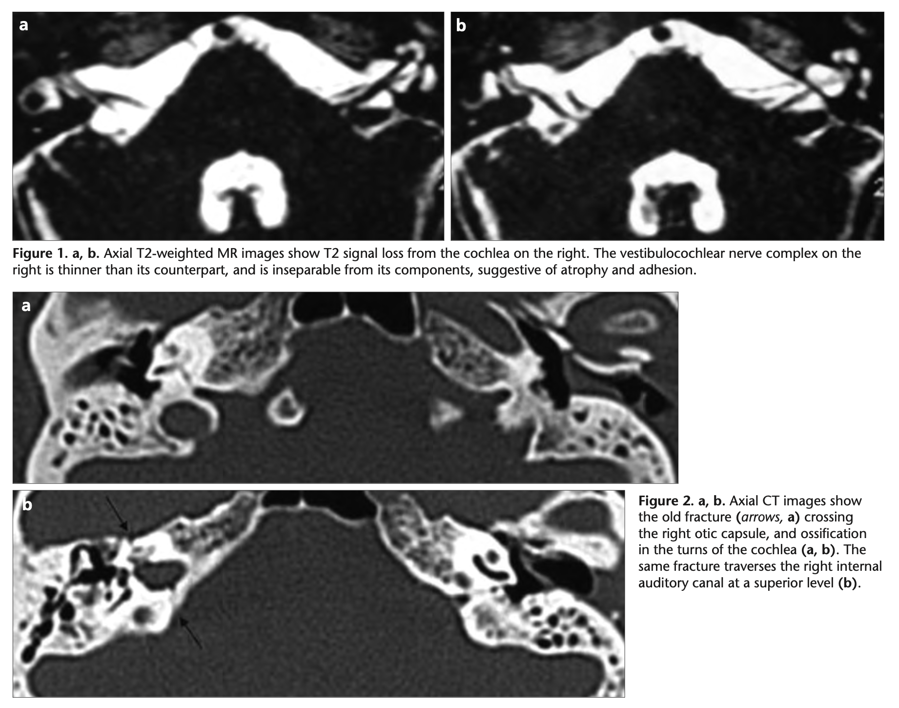 Figure: Labyrinthine ossification following a right temporal bone transverse fracture.  MRI of the internal auditory canals (top panels).  Temporal bone CT (middle and bottom panels).  From Aralasmak and colleagues (2009).
