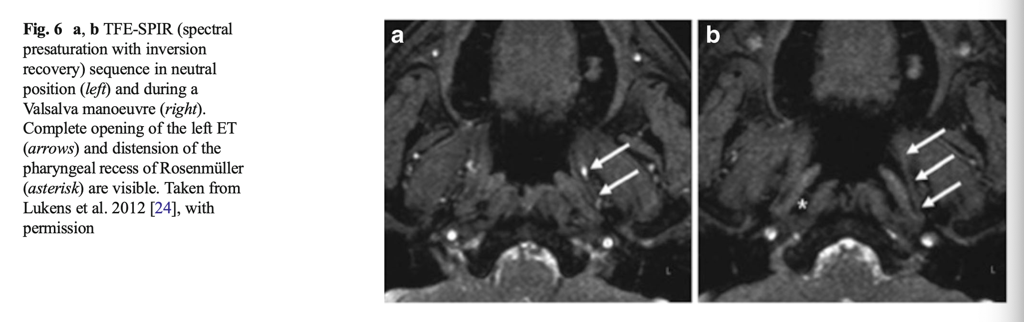 Figure: MRI from a healthy volunteer images the Eustachian tube at rest (panel a) and during Valsalva (panel b), from Smith et al. (2016).