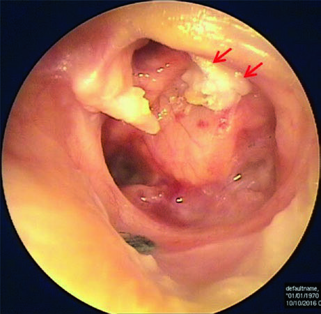 Figure: Otoscope showing left ear with marginal perforation with secondary acquired cholesteatoma due to a migration of the skin epidermis on the edge of the perforation inside the middle ear cavity (red arrows).  From Mansour et al. (2018).