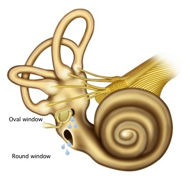 Figure: Perilymph fistula at oval and round window.  From https://lmhofmeyr.co.za/conditions/dizziness-and-balance-disorders/perilymph-fistula/ (accessed 2/5/23).