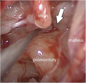Figure: Perilymphatic leak from the anterior oval window (arrow) adjacent to the fractured stapes footplate. Image is of the right ear (right is anterior; top is superior).  From Rafal et al. (2021).
