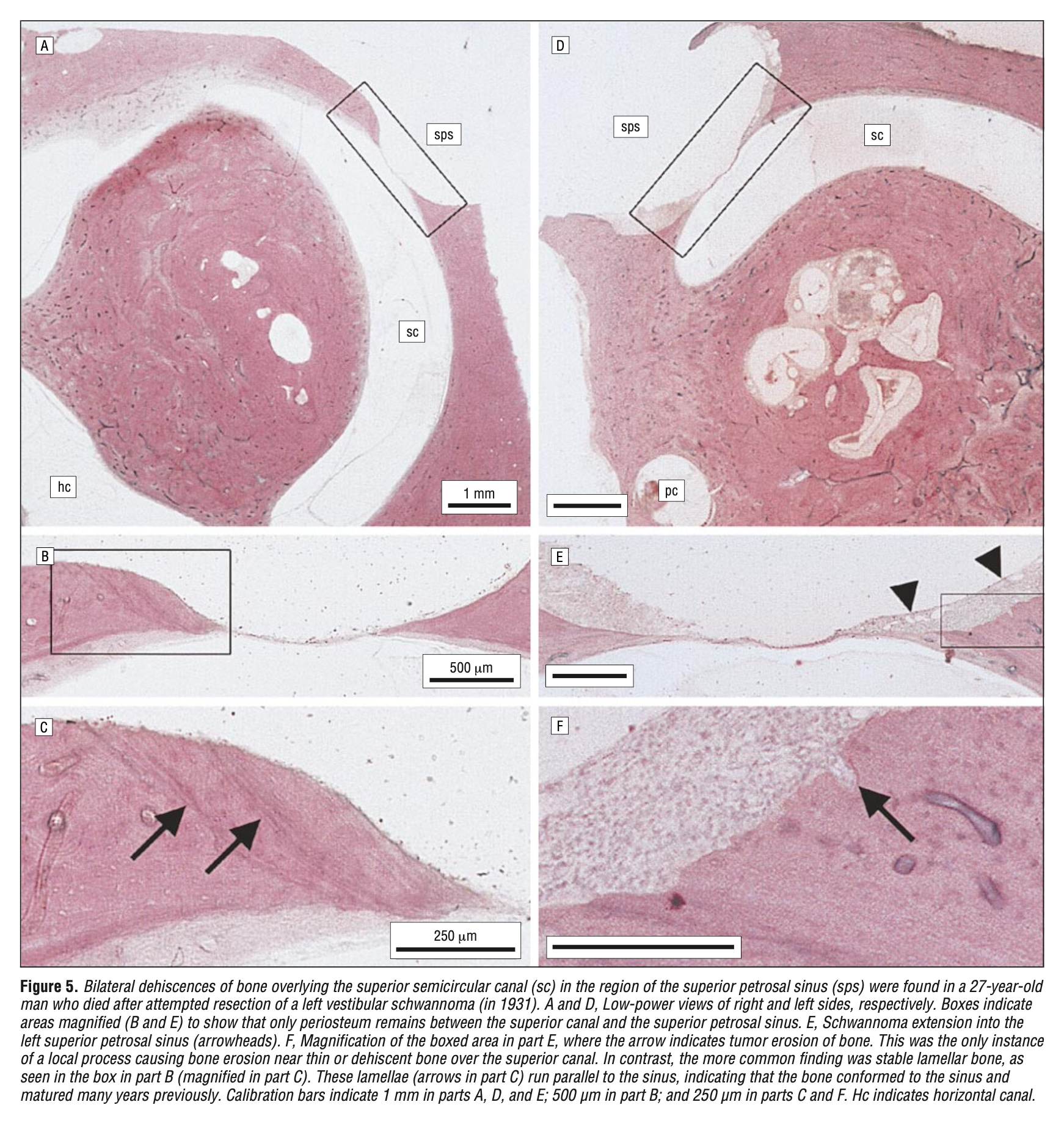 Figure: Post-mortem surgical pathology of a patient with bilateral superior semicircular canal dehiscence, from Carey et al. (2000).