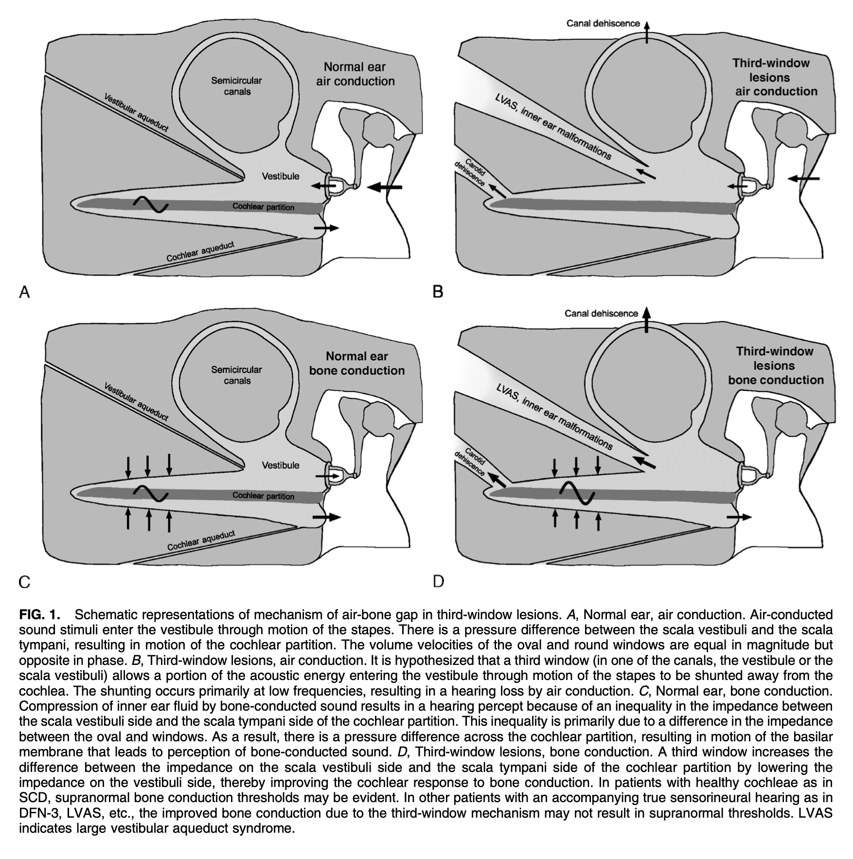 Figure: Schematic depiction of third window phenomena with air conducted and bone conducted sound, from Merchant and Rosowski (2008).