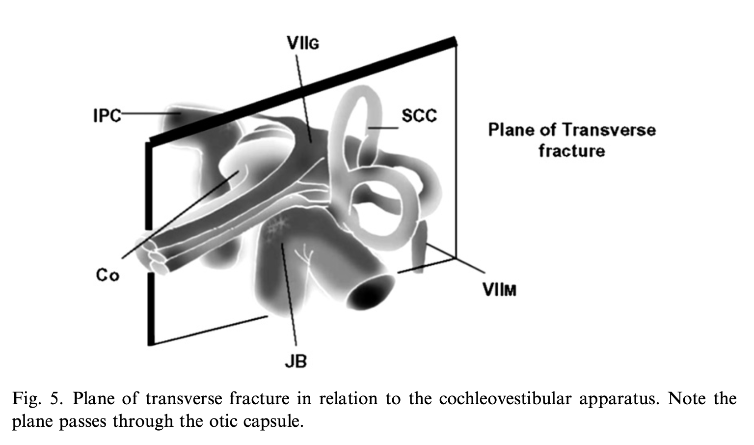 Figure: Schematic of a transverse temporal bone fracture passing through the otic capsule.  From Johnson et al (2008).