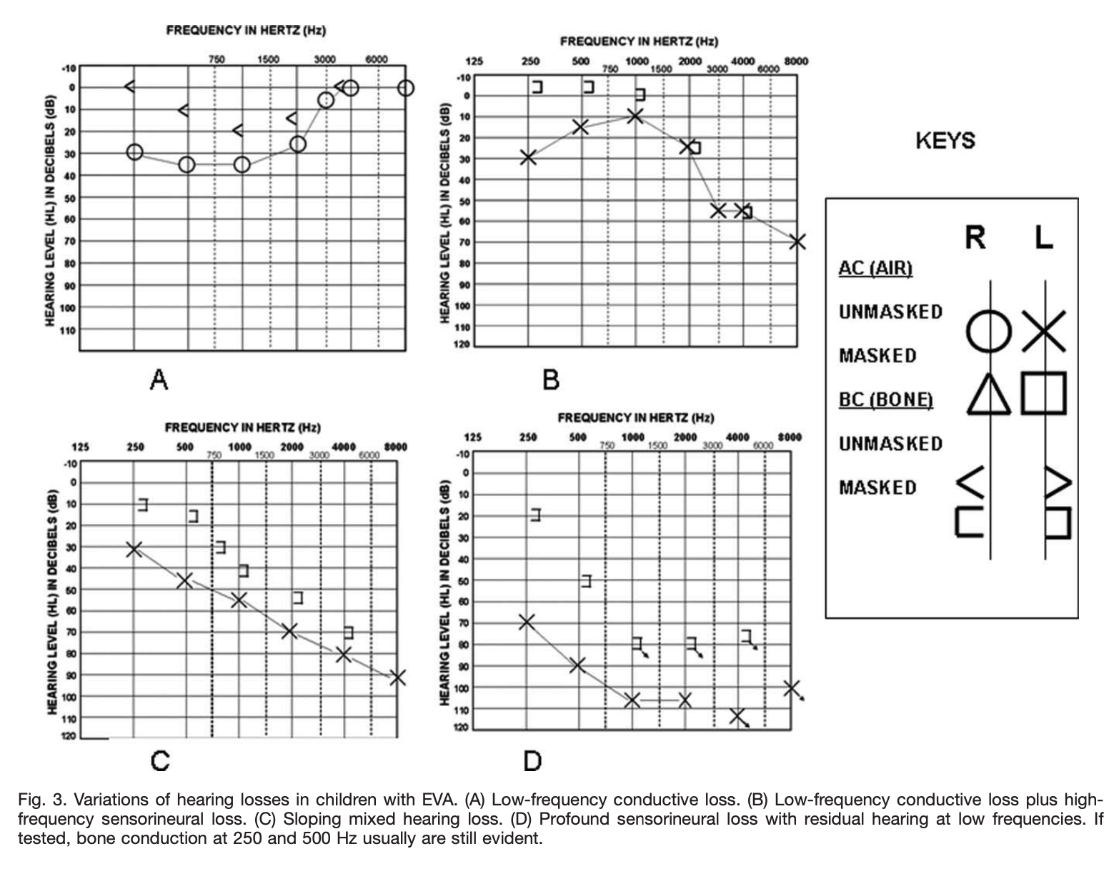 Figure: Several audiograms from pediatric patients with large vestibular aqueduct showing different patterns of hearing loss.  From Zhou and Open (2011).