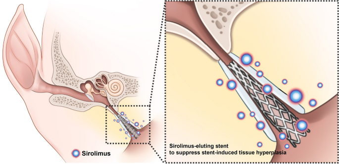 Figure: Sirolimus-eluting stent placed in a porcine Eustachian tube, from Kang et al. (2022).