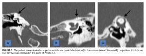 Figure: Temporal bone CT of a patient with superior semicircular canal dehiscence showing three reconstructions: coronal (panel A), Stenver's plane (panel B) and Pöschl's plane (panel C), from Duman and Dogan (2020).