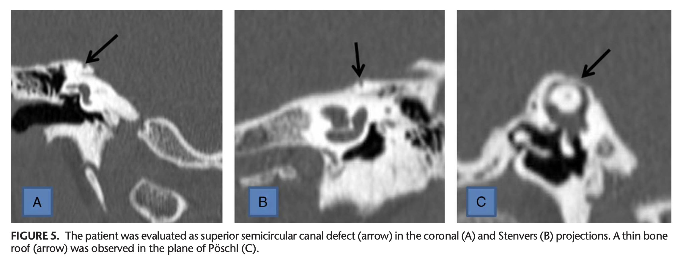 Figure: Temporal bone CT of a patient with superior semicircular canal dehiscence showing three reconstructions: coronal (panel A), Stenver's plane (panel B) and Pöschl's plane (panel C), from Duman and Dogan (2020).