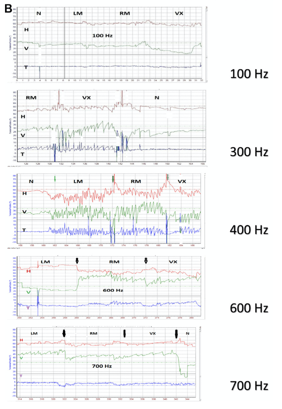 Figure: The nystagmus resulting from skull vibration at different frequencies in a patient with right-sided superior semicircular canal dehiscence.  From Dumas et al. (2019).