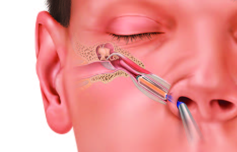Figure: Transnasal balloon dilation Eustachian tuboplasty.  From https://www.drmmacdonald.com/blocked-ears/ (accessed 2/16/23).