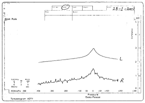 Figure: Tympanogram showing right ear compliance changes, from Abdul-Baqi (2004).