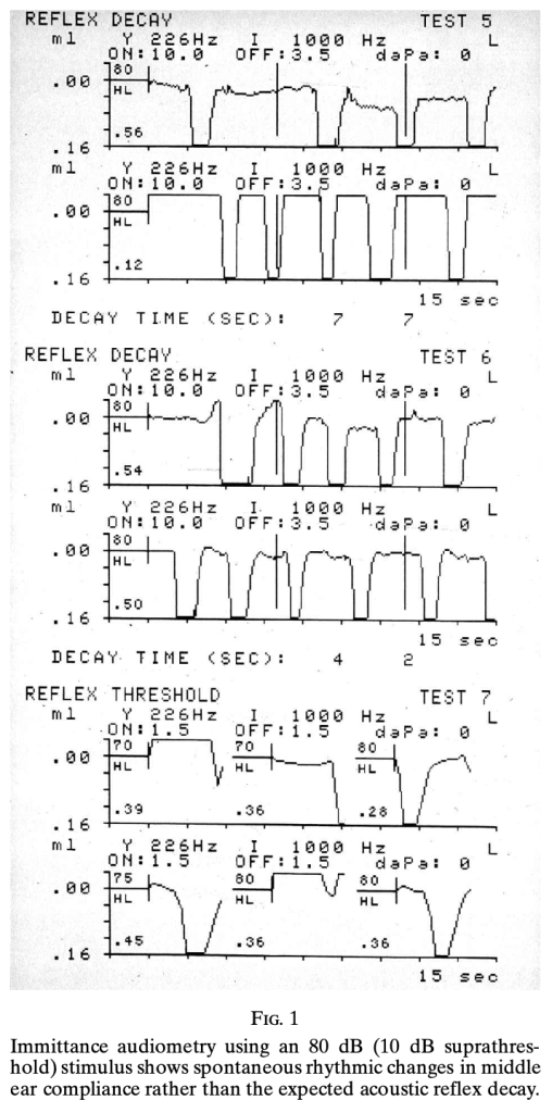 Figure: Impedance tympanometry of a patient with middle ear myoclonus  (from Zipfel et al. 2000).  In this case it was unclear whether the etiology was tensor tympani myoclonus or stapedial myoclonus.