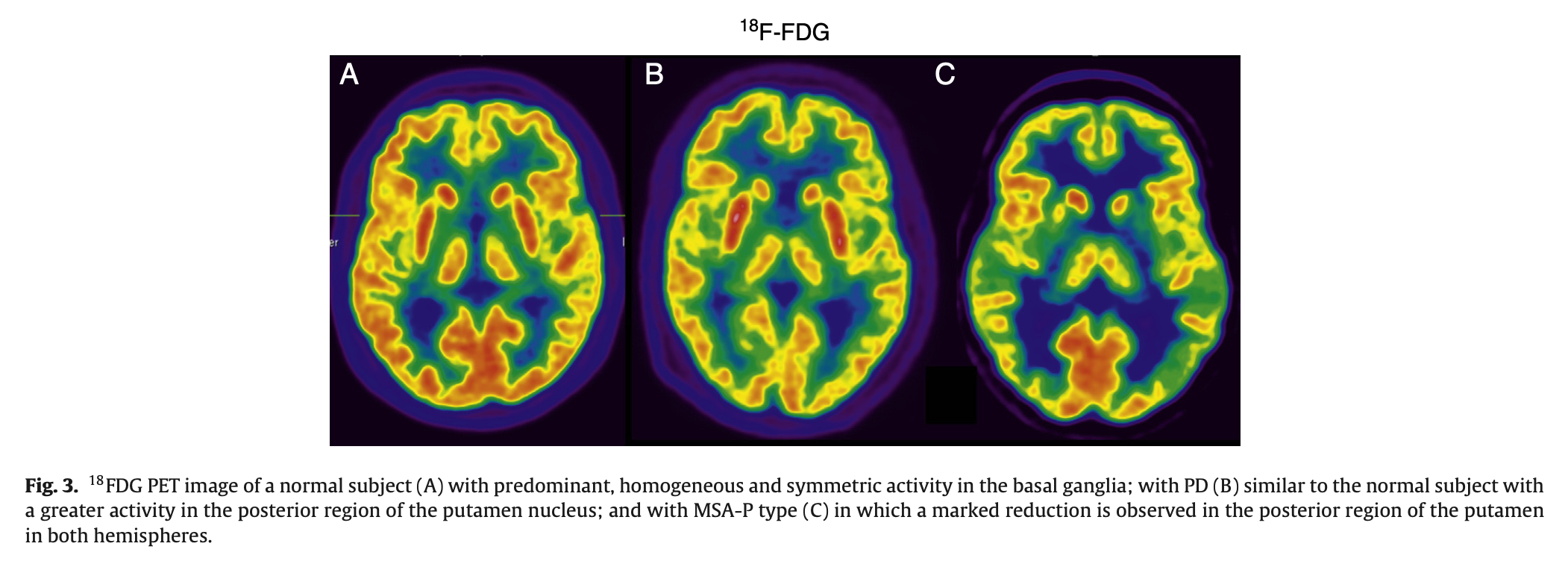 Figure: 18F-fluorodeoxyglucose positron emission tomography scans from a healthy individual (panel A), a patient with idiopathic Parkinson's disease (panel B) and a patient with the parkinsonian variant of multiple system atrophy (panel C).  From Abrizu et al. (2014).