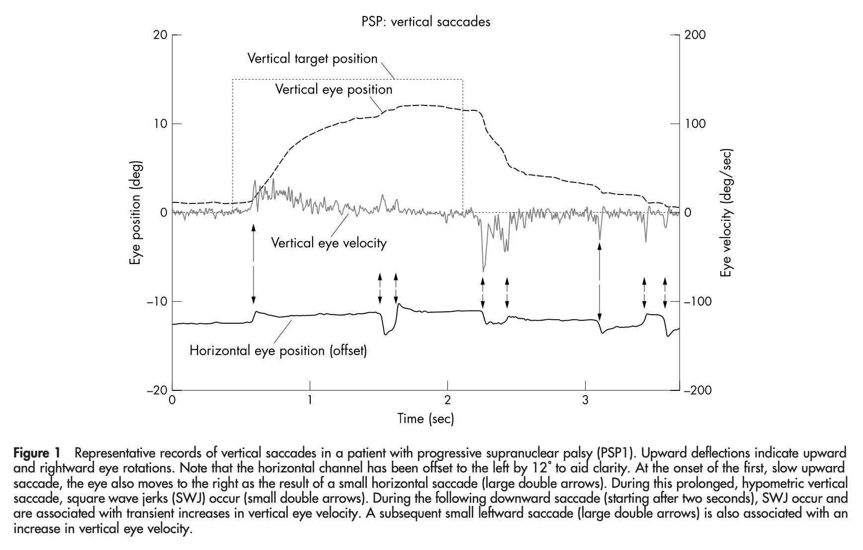Figure: Abnormal vertical optokinetic responses in a patient with progressive supranuclear palsy.  From Garbut et al. (2004).
