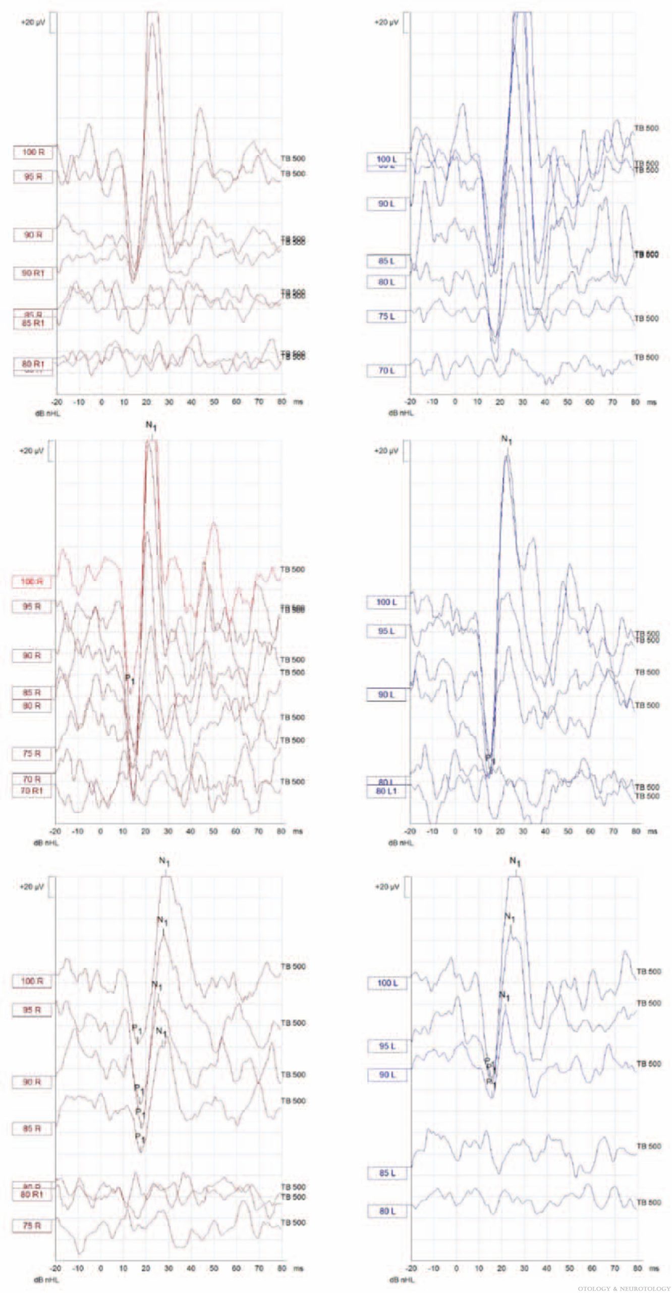 Figure: Abnormally large amplitudes in cervical vestibular evoked myogenic potentials from patients with Pendred syndrome.  From West et al. (2021).