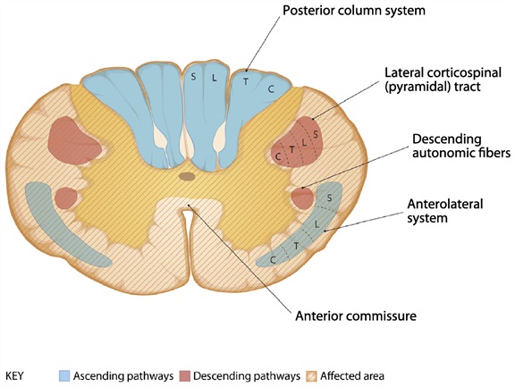 Figure: Anterior cord syndrome.  Adapted from Cho (2015).