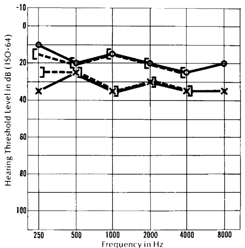 Figure: Audiogram from a 41-year-old woman with Chiari 1 malformation showing mild sensorineural hearing loss on the left.  From Rydell et al. (1971).